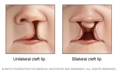 Unilateral and bilateral cleft lip