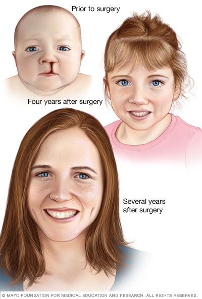 Cosmetic results of cleft lip repair