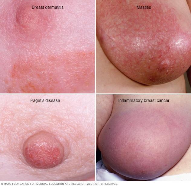 Red spots on breast