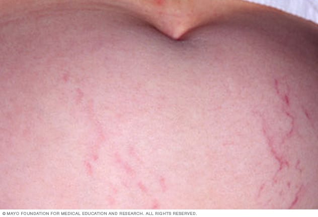 Skal Parat Ingen Stretch marks - Symptoms and causes - Mayo Clinic