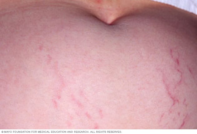 Stretch marks - Symptoms and causes - Mayo