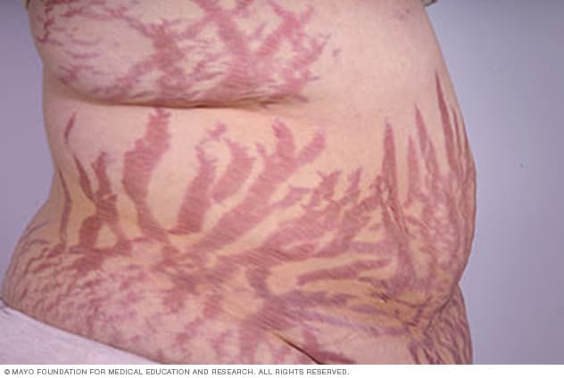 Stretch marks - Symptoms and causes - Mayo
