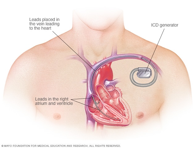 Implanteerbare cardioverter-defibrillator (ICD)