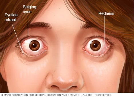 Photograph showing eye complications associated with Graves' disease