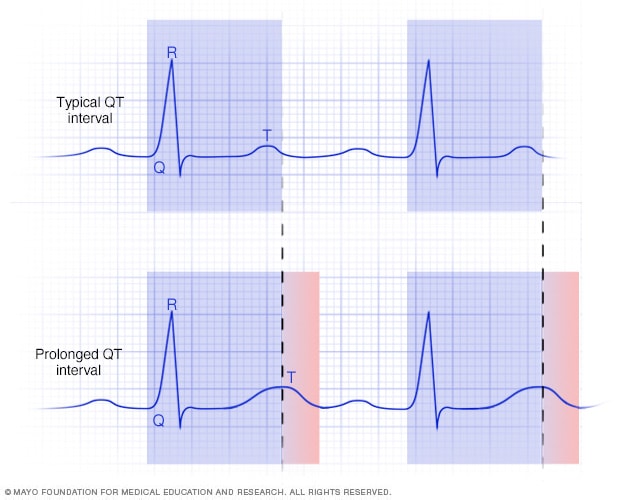 Gráficos de intervalos QT normales y largos