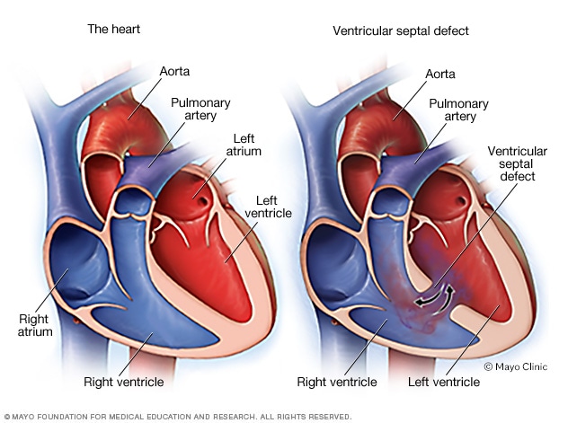 Comunicación interventricular