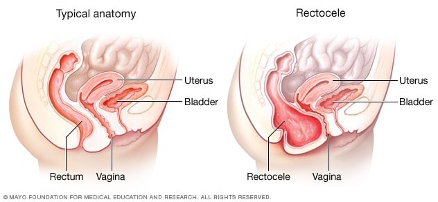 Pussy Prolapse