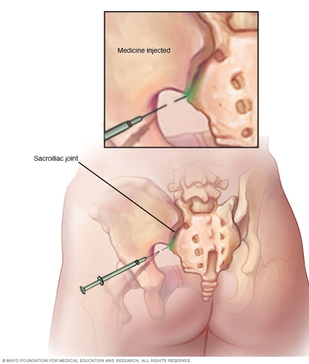 Sacroiliitis - Diagnosis and - Mayo Clinic