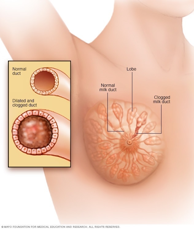 乳腺导管扩张症中被阻塞的乳腺导管