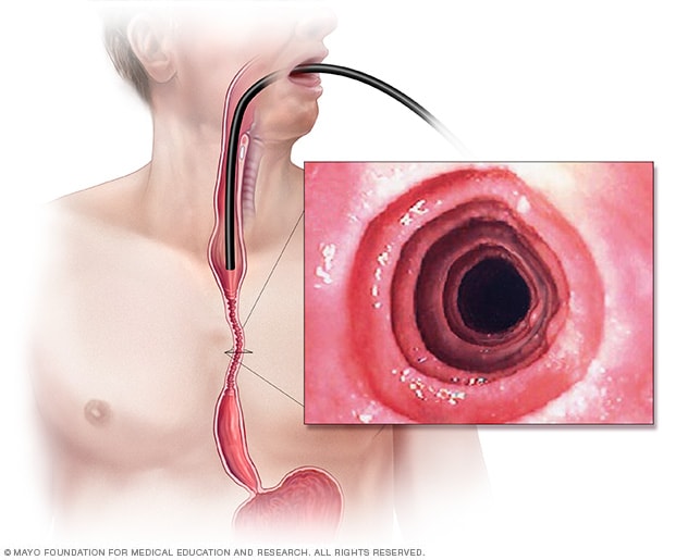 Eosinophilic Esophagitis - El Atlas Gastrointestinal -  gastrointestinalatlas.com