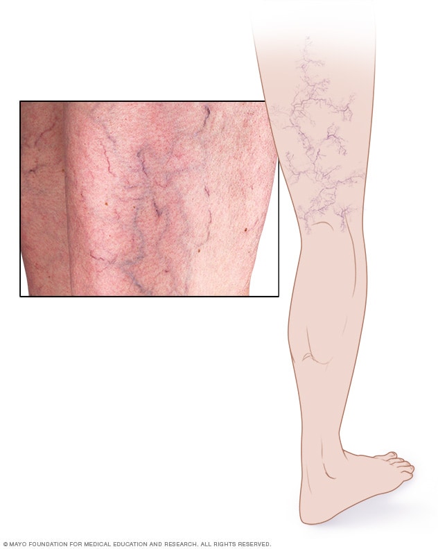 Varicose veins - Symptoms and causes - Mayo Clinic