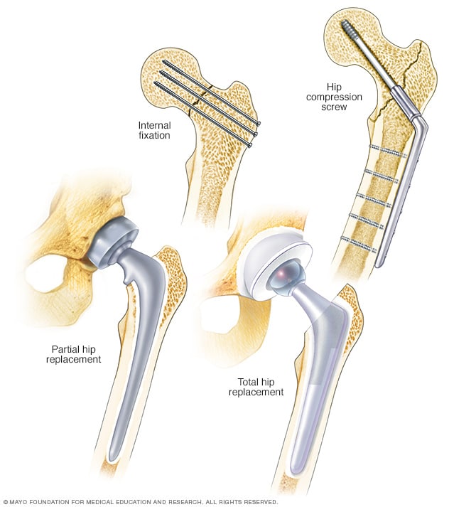 Ilustración de una variedad de técnicas para reparar la cadera. 
