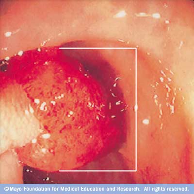 Large polyp