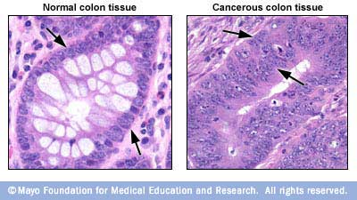 Imagen del tejido de un colon saludable comparada con la del tejido de un colon canceroso 