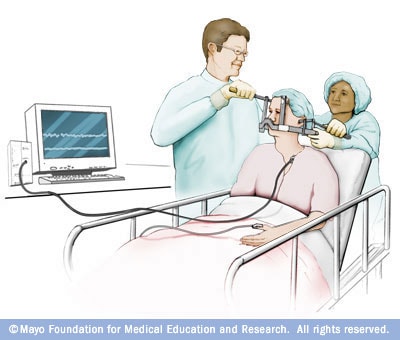 Illustration of Gamma Knife head frame 