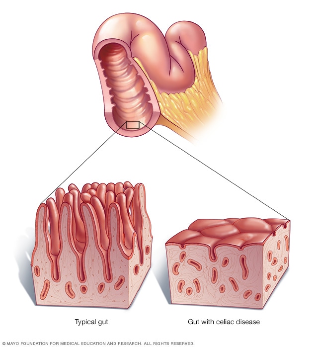 Vellosidades intestinales | Guiaceliacos