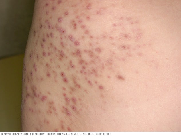 Folliculitis - Symptoms and causes - Mayo Clinic