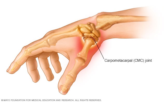 Carpal osteoarthritis