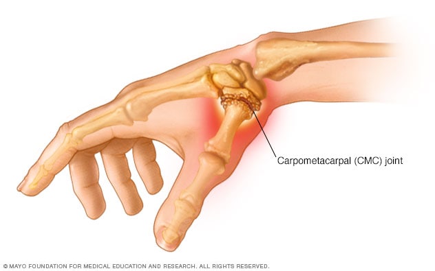 Artritis del pulgar 