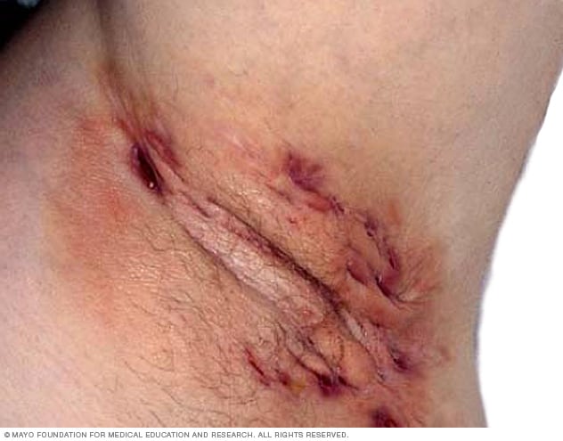 Hidradenitis suppurativa - Symptoms and causes - Mayo Clinic Hidradenitis suppurativa - Symptoms and causes - Mayo Clinic