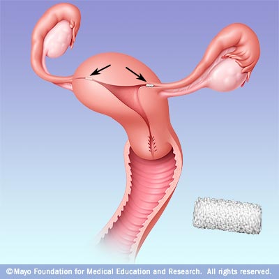 Illustration showing Adiana placement 
