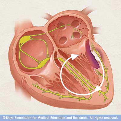 Illustration showing ventricular tachycardia 
