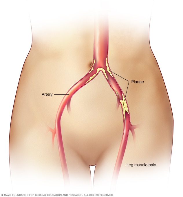 Peripheral artery disease symptoms hotsell