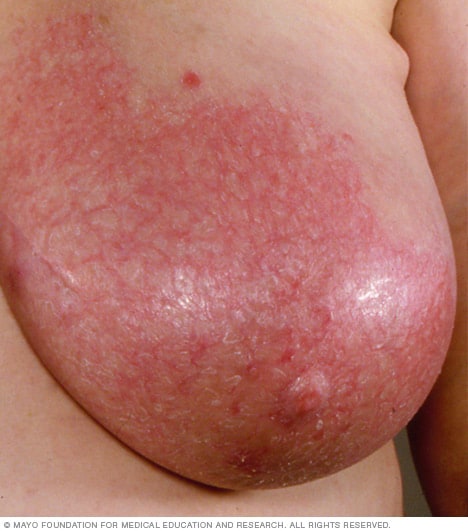 Una mujer con mastitis