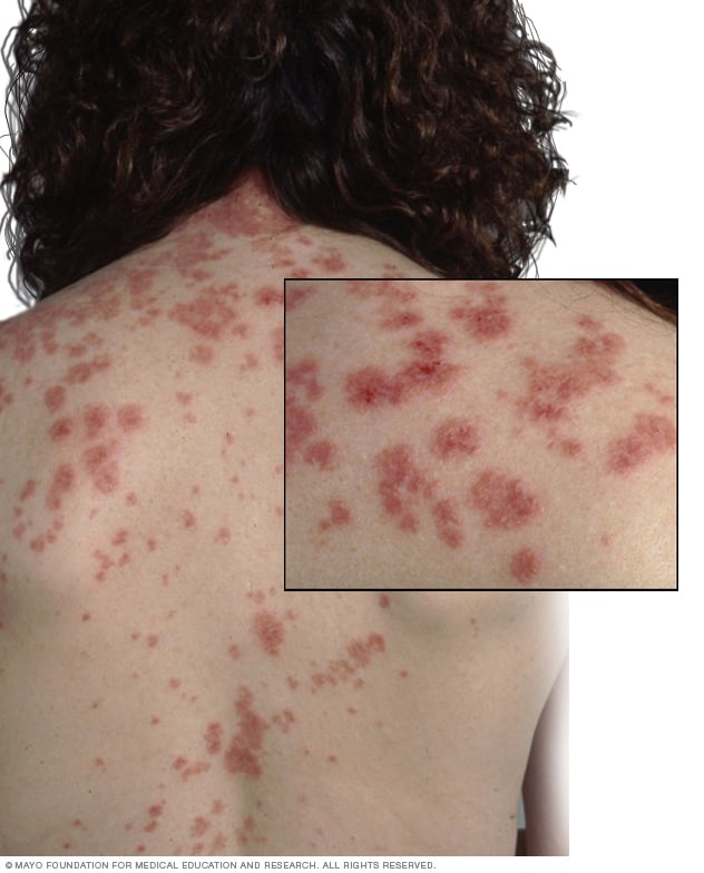 Sweet syndrome rash on a back