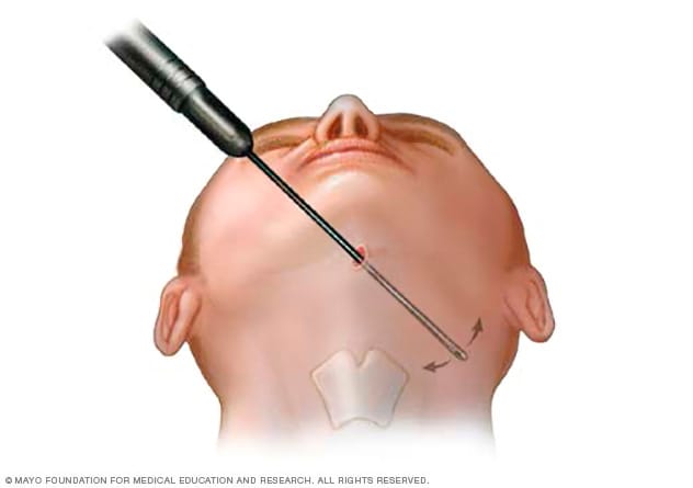 Suction-assisted liposuction procedure to remove fat under chin