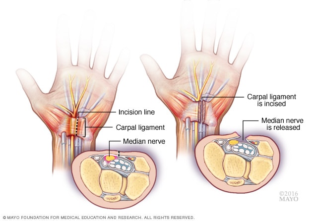 Carpal Tunnel Syndrome Treatment | South Florida Hand Center