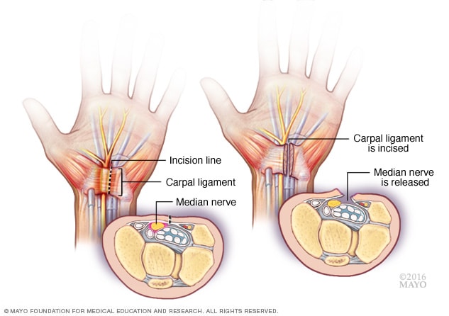 Carpal tunnel release procedure