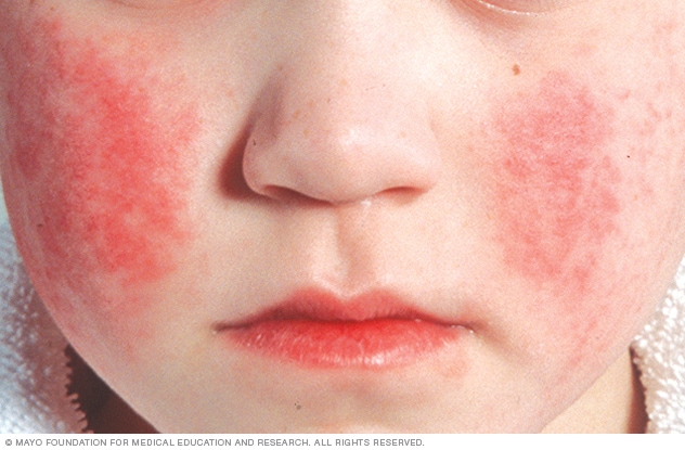 Sarpullido facial por infección de parvovirus