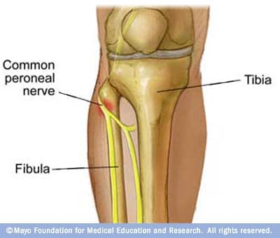 Illustration of peroneal nerve 
