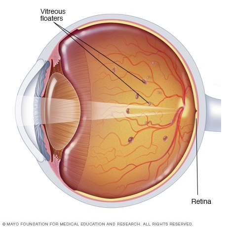 Eye floaters - Symptoms and causes - Mayo Clinic