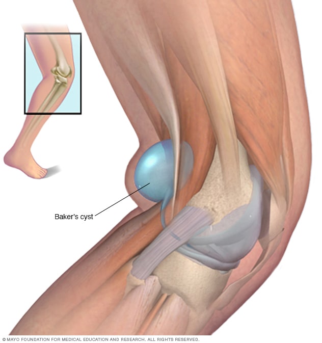 Baker's cysts treatment and exercise