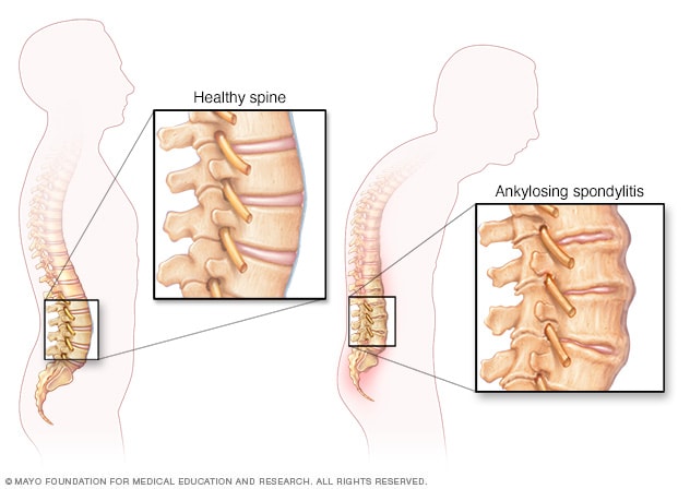 Ankylosing spondylitis - Symptoms and causes - Mayo Clinic