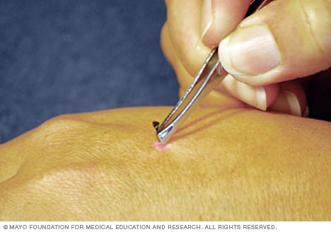 Removing A Bee S Stinger Mayo Clinic