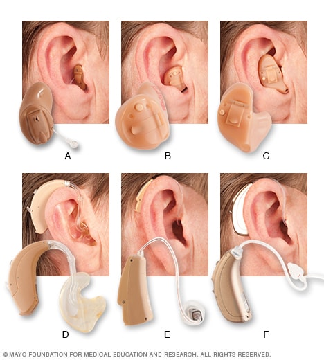 Tipos de audífonos comunes
