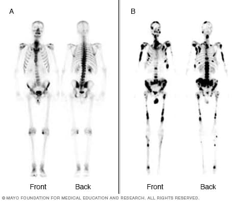 Bbone scans depicting hot spots