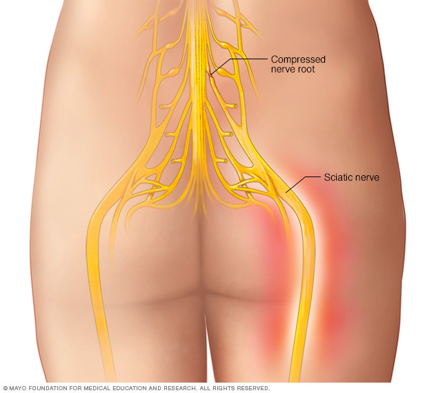 what causes sciatica to flare-up