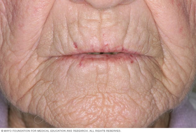 Limited Scleroderma Symptoms And Causes Mayo Clinic