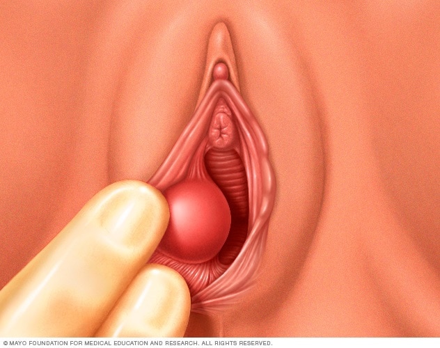 Pdf posterior vaginal wall cyst mimicking rectocele