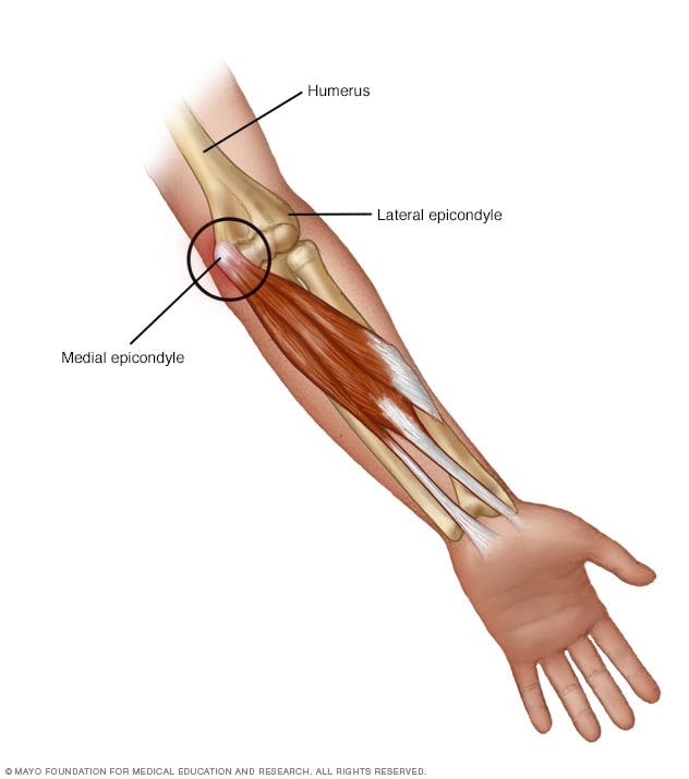 Epicondylitis medial Epicondilitis medial