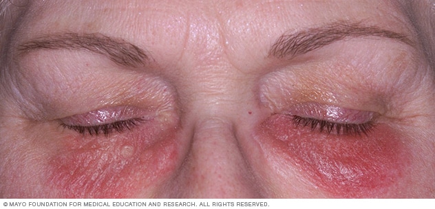 التهاب الجلد التماسي تحت العينين قد ينتج عن استخدام مستحضرات التجميل