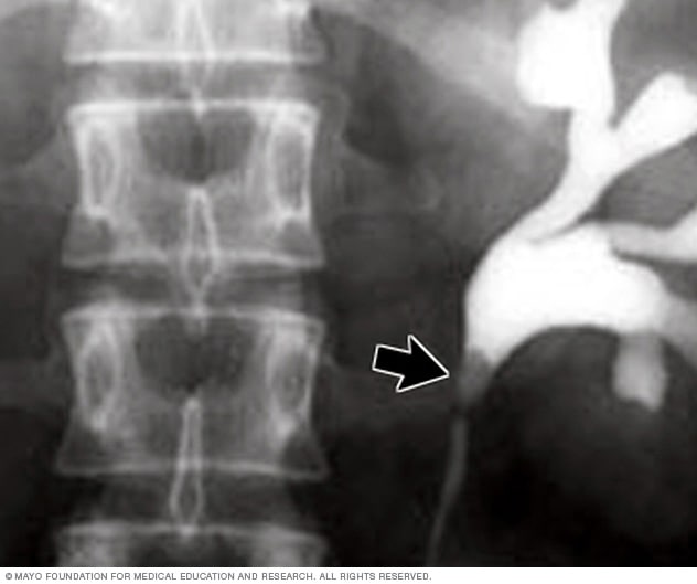 肾结石的 X 线图像