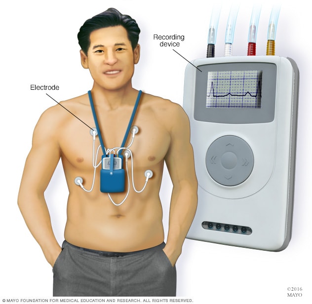 Holter - Monitor removal
