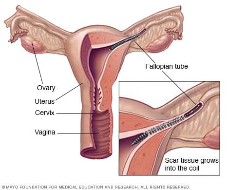 Essure - Mayo Clinic mirena insertion diagram 