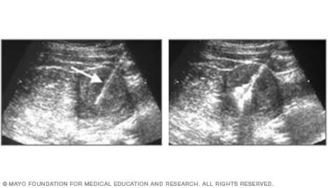 Ultrasound image showing a needle entering a tumor