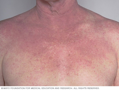 Atopic dermatitis on the chest